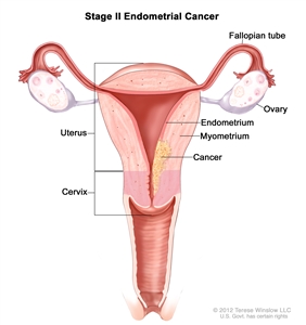 Stage II endometrial cancer shown in a cross-section drawing of the uterus, cervix, fallopian tubes, ovaries, and vagina. Cancer is shown in the endometrium and myometrium of the uterus and in the cervix.