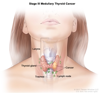 Stage III medullary thyroid cancer; drawing shows cancer in the thyroid gland and in nearby lymph nodes. Also shown are the trachea and larynx.