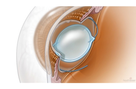 Cataract Surgery