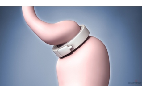 Laparoscopic Gastric Banding