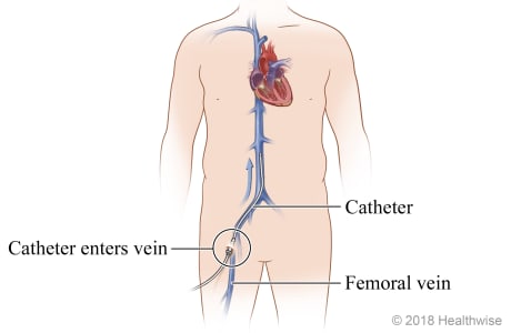 Femoral vein and its location near the groin, where catheter enters vein