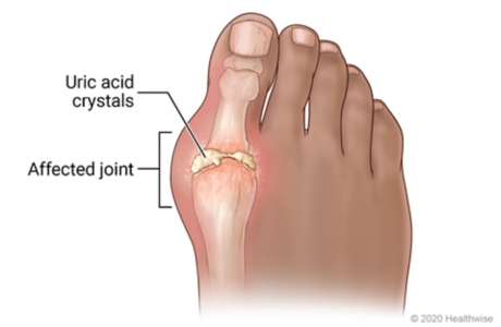 Picture of gout in the big toe