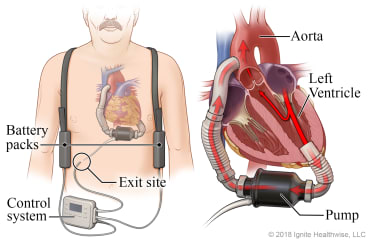 Location of VAD pump, battery packs, and controller, with detail of VAD pumping blood from heart's left ventricle to the aorta.