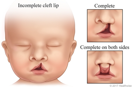 Faces of babies, showing three kinds of cleft lip: incomplete, complete, and complete on both sides