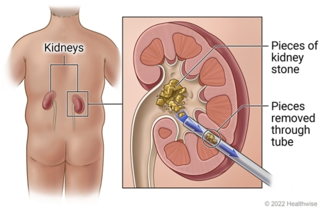 Left and right kidneys in person's back, with detail inside kidney showing kidney stone broken into pieces and being removed through tube.