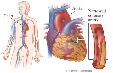 Heart, with detail of coronary artery narrowed by plaque