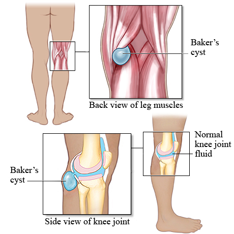 Baker's cyst