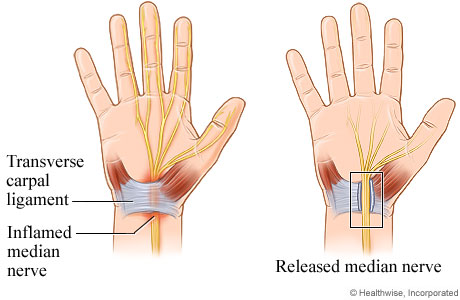 Open carpal tunnel release surgery