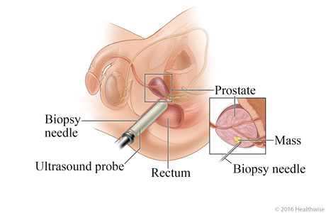 Picture of transrectal prostate biopsy