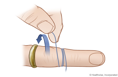 Removing a ring from a finger or toe