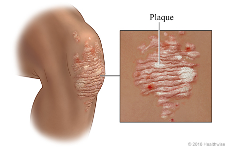 Psoriasis plaque on a knee.