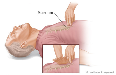 Positioning the hands for chest compressions.