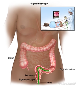 Sigmoidoscopy; drawing shows a sigmoidoscope inserted through the anus and rectum and into the sigmoid colon. An inset shows a patient lying on a table having a sigmoidoscopy.