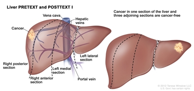 Liver PRETEXT and POSTTEXT I; drawing shows two livers. Dotted lines divide each liver into four vertical sections of about the same size. In the first liver, cancer is shown in the section on the far left. In the second liver, cancer is shown in the section on the far right.