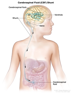 Drawing shows extra cerebrospinal fluid (CSF) flowing through a shunt (a long, thin tube) from a ventricle (fluid-filled space) in the brain into the abdomen. The shunt goes from the ventricle, under the skin in the neck and chest, and into the abdomen. Also shown is a shunt valve that controls the flow of CSF.