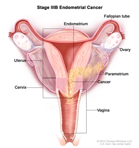 Stage IIIB endometrial cancer shown in a cross-section drawing of the uterus, cervix, fallopian tubes, ovaries, and vagina. Cancer is shown in the endometrium of the uterus, the parametrium, the cervix, and the vagina.