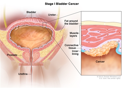 Stage I bladder cancer (non-muscle-invasive bladder cancer); drawing shows the bladder, ureter, prostate, and urethra. An inset shows cancer in the inner lining of the bladder and in the layer of connective tissue next to it. Also shown are the muscle layers of the bladder and the layer of fat around the bladder.