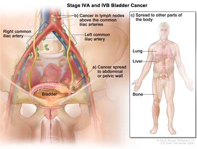 Stage IVA and IVB bladder cancer; drawing shows cancer that has spread from the bladder to (a) the abdominal or pelvic wall and (b) lymph nodes above the common iliac arteries. Also shown is cancer that has spread to (c) other parts of the body, including the lung, liver, and bone.