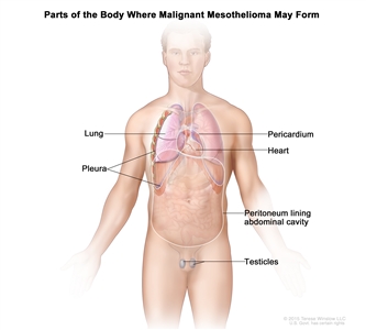 Drawing shows parts of the body where malignant mesothelioma may form, including the pleura (the tissue that lines the chest cavity and covers the lungs), the pericardium (the tissue that surrounds the heart), the peritoneum (the tissue that lines the abdomen and covers most of the organs in the abdomen), and the testicles. The heart and lungs are also shown.