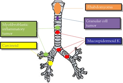 Drawing showing the most representative primary tracheobronchial tumors in children: myofibroblastic inflammatory tumor, carcinoid, rhabdomyoma, granular cell tumor, and mucoepidermoid K.