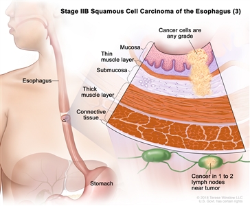 Stage IIB squamous cell carcinoma of the esophagus (3); drawing shows the esophagus and stomach. An inset shows cancer cells of any grade in the mucosa layer, thin muscle layer, and submucosa layer of the esophagus wall. Also shown are the thick muscle layer and connective tissue layer of the esophagus wall and cancer in 1 lymph node near the tumor.