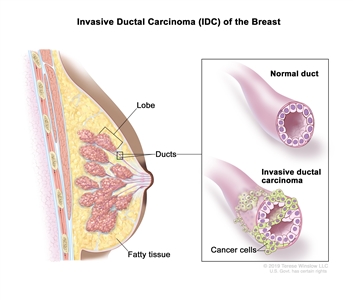 Invasive ductal carcinoma (IDC) of the breast; drawing shows a lobe, ducts, and fatty tissue in a cross section of the breast. An inset shows a normal duct and a duct with IDC and cancer cells spreading outside it.