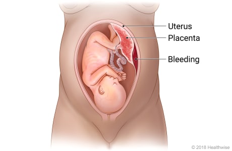 Baby in uterus, showing placenta separated from wall of uterus and bleeding.