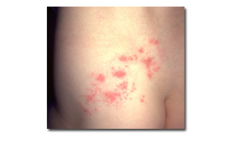 Shingles rash