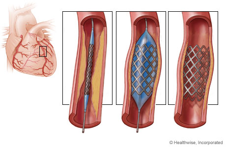 Coronary stent