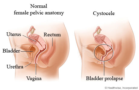 Cystocele.