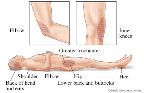 Areas where pressure injuries commonly develop.