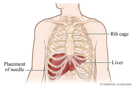 Where a liver biopsy needle is placed between two right lower ribs