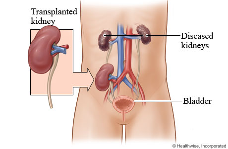 Transplanted kidney