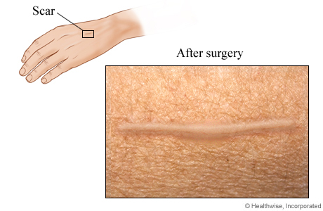 Scar after excision for melanoma