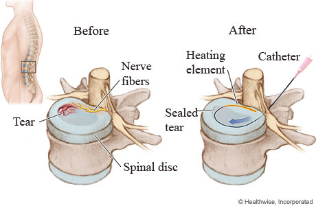 Intradiscal electrothermal therapy (IDET) catheter and heating element placement.