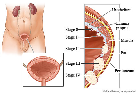 Bladder cancer stages