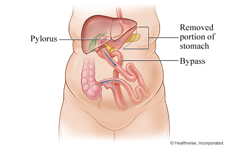 Biliopancreatic diversion with duodenal switch