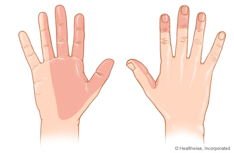 Areas of skin feeling supplied by the median nerve