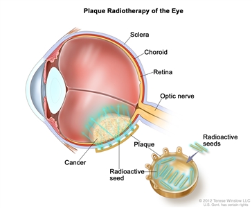 Drawing of a cross-section of the eye showing the sclera, choroid, retina, and optic nerve. An inset shows a plaque with radioactive seeds that is placed on the outside of the eye. The seeds are aimed at the cancer.