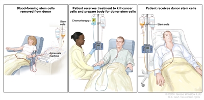 Donor stem cell transplant; (Panel 1): Drawing of stem cells being collected from a donor's bloodstream using an apheresis machine. Blood is removed from a vein in the donor's arm and flows through the machine where the stem cells are removed. The rest of the blood is then returned to the donor through a vein in their other arm. (Panel 2): Drawing of a health care provider giving a patient an infusion of chemotherapy through a catheter in the patient's chest. The chemotherapy is given to kill cancer cells and prepare the patient's body for the donor stem cells. (Panel 3): Drawing of a patient receiving an infusion of the donor stem cells through a catheter in the chest.