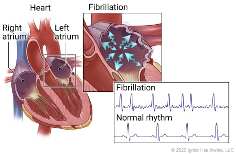 Right and left atria of heart with details showing fibrillation in an atrium, and EKG patterns of fibrillation and normal rhythm. Right and left atria of heart with details showing fibrillation in an atrium, and EKG patterns of fibrillation and normal rhythm.