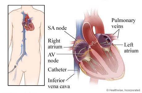 How a catheter is inserted through a vein to the heart. How a catheter is inserted through a vein to the heart.