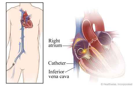 View of catheter from groin to heart, with detail of catheter in the atrium. View of catheter from groin to heart, with detail of catheter in the atrium.