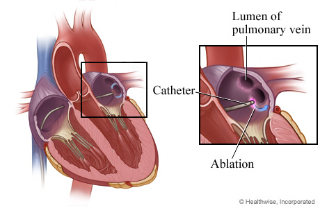 Heart tissue is destroyed (ablation). Heart tissue is destroyed (ablation).