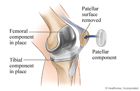 Knee replacement surgery: Patellar component Knee replacement surgery: Patellar component