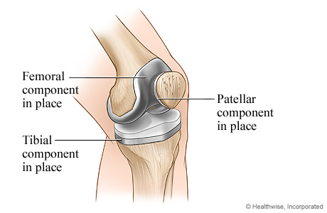 Completed knee replacement surgery Completed knee replacement surgery