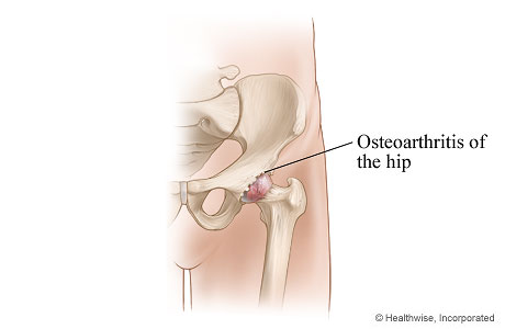 Hip joint affected by osteoarthritis Hip joint affected by osteoarthritis