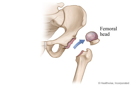 Hip replacement: Damaged cartilage and bone are removed Hip replacement: Damaged cartilage and bone are removed