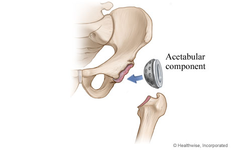 Hip replacement: Hip socket component is placed Hip replacement: Hip socket component is placed