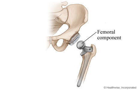Hip replacement: Femoral component is placed Hip replacement: Femoral component is placed
